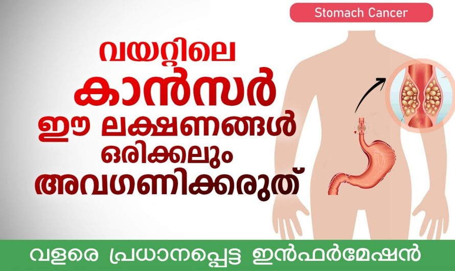 ഈ 4 ലക്ഷണങ്ങൾ ഒരിക്കലും അവഗണിക്കരുത് | വളരെ പ്രധാനപ്പെട്ട ഇൻഫർമേഷൻ വയറ്റിലെ കാൻസർ