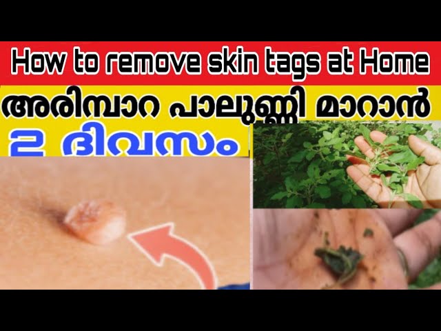 വേദന ഇല്ലാതെ പാലുണ്ണി, അരിമ്പാറ രണ്ട് ദിവസത്തിനുള്ളിൽ അടർന്നുവീഴും|