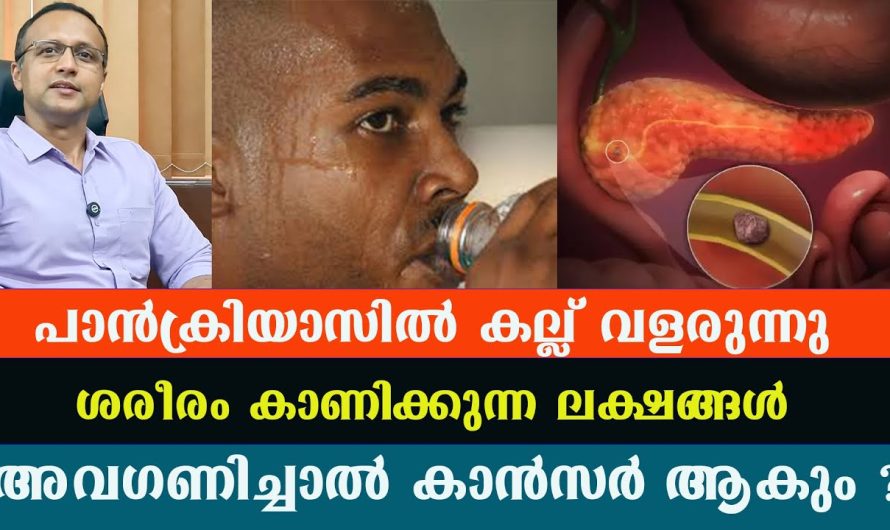 പാൻക്രിയാസിൽ കല്ല് വളരുന്നു ശരീരം കാണിക്കുന്ന ലക്ഷങ്ങൾ ,അവഗണിച്ചാൽ കാ..ൻ..സ.ർ ആകും ?