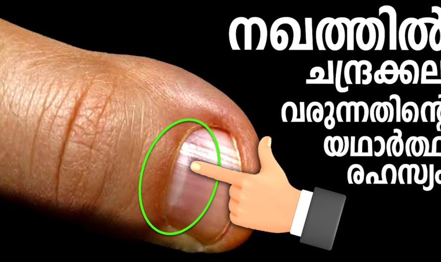 നഖത്തിൽ ചന്ദ്രക്കല കണ്ടാൽ ഉടനെ ചെയ്യേണ്ടത്