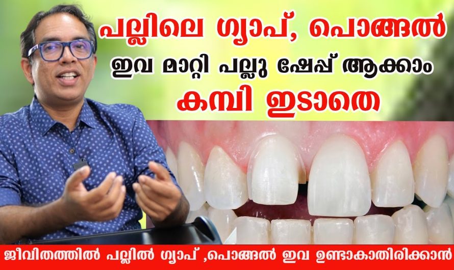 പൊങ്ങിയ പല്ലുകൾ കമ്പിയിടാതെ താഴ്ന്നു ഷേപ്പ് ആകും ഇങ്ങനെ ചെയ്താൽ