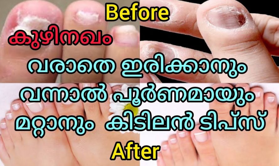 കാലുകളിലെ കുഴിനഖം മാറ്റി കാലുകൾ സുന്ദരമാക്കാം..